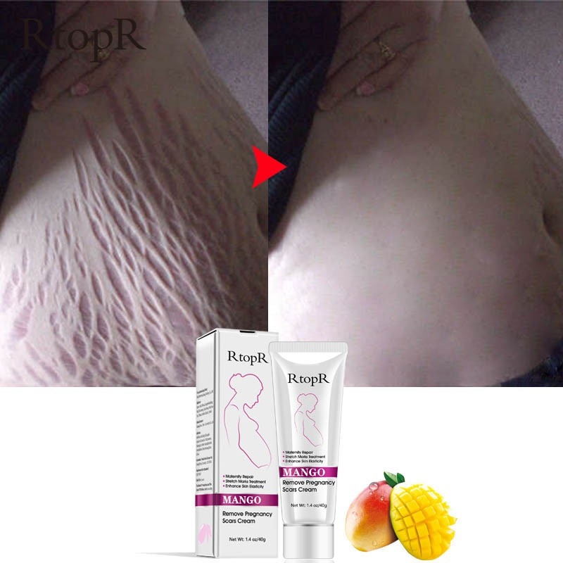 Natural Mild Non-irritating Mango Stretch Mark Cream For Pregnancy Repair Scar Slack Line Abdomen Stretch Marks Cream